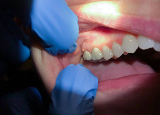 Best Emergency Broken Tooth Repair in USA